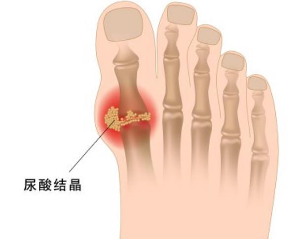 痛风最新治疗方案详解，探索与理解实践指南